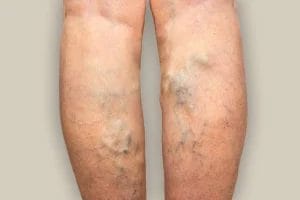 Exempel pa Aderbrack